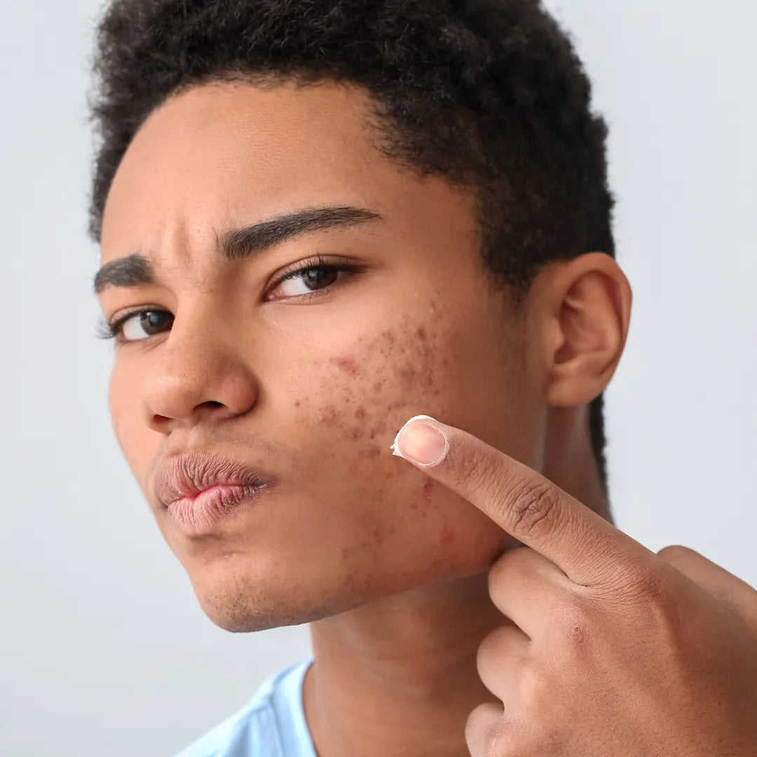 The Ultimate Guide to Hyperpigmentation: Causes, Treatments & Prevention