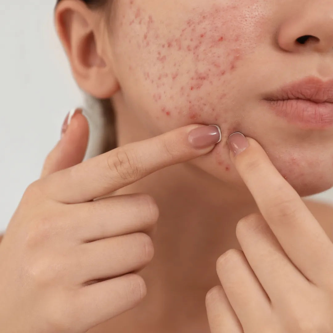 Close up of person touching acne on cheek
