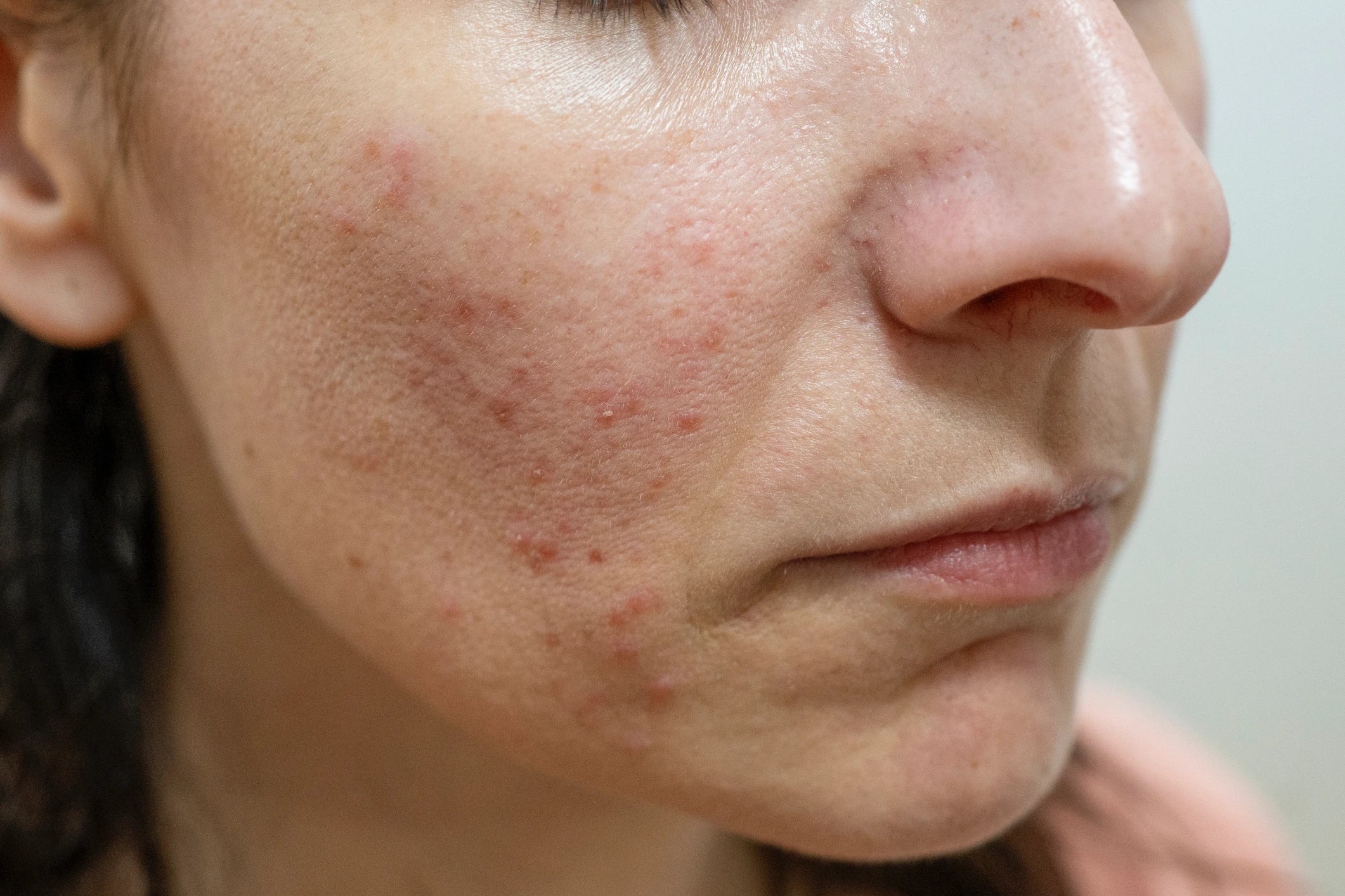 Close-up of a person’s face with visible spots, highlighting skin texture for skincare purposes.