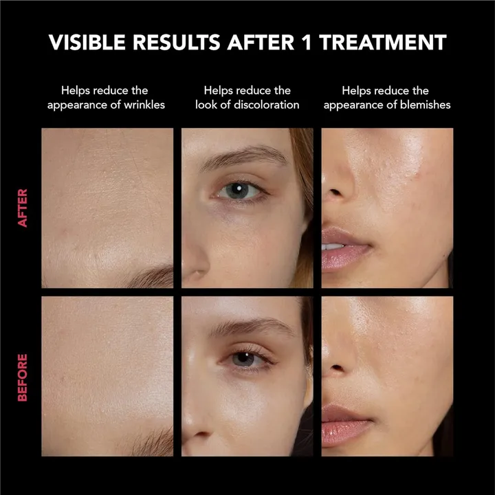 Before and after comparison of skin treatment showing reduced wrinkles, discoloration, and blemishes.