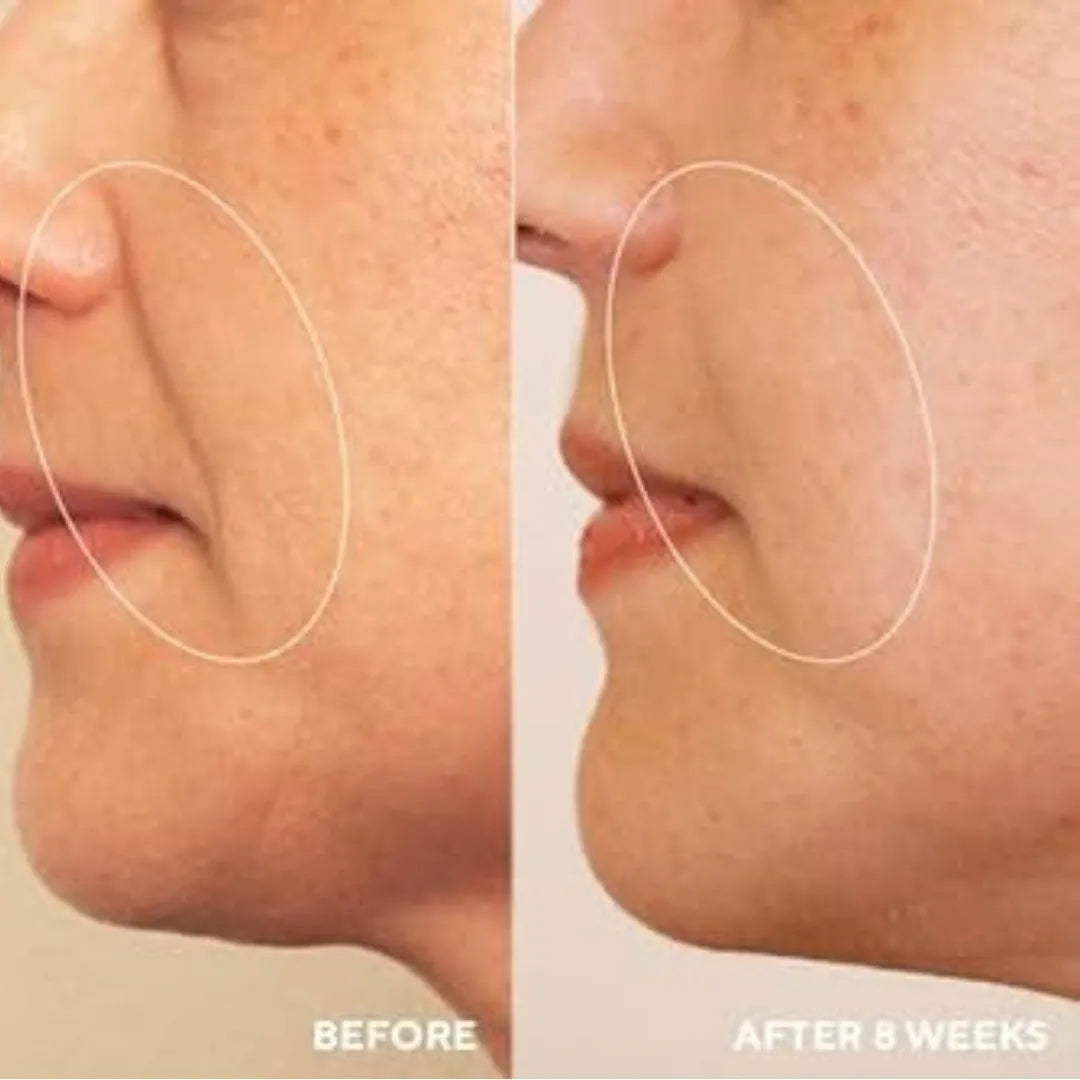 Before and after photos showing visibly reduced skin folds.