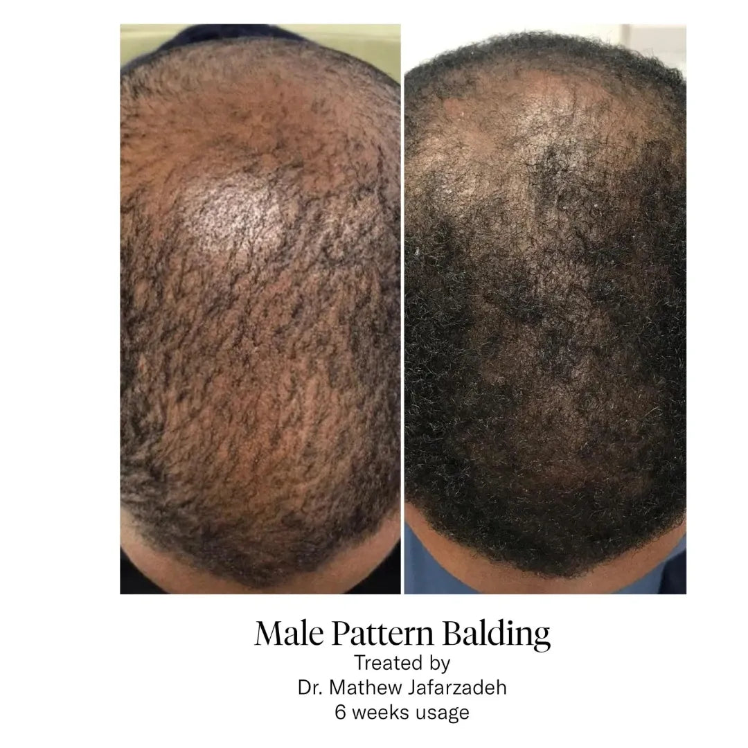 two photos side by side, titled male pattern balding showing difference after 6 weeks usage