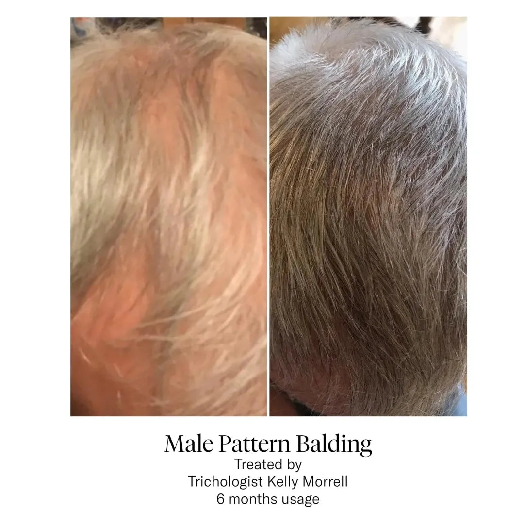 Male pattern balding photos, before and after 6 months usage