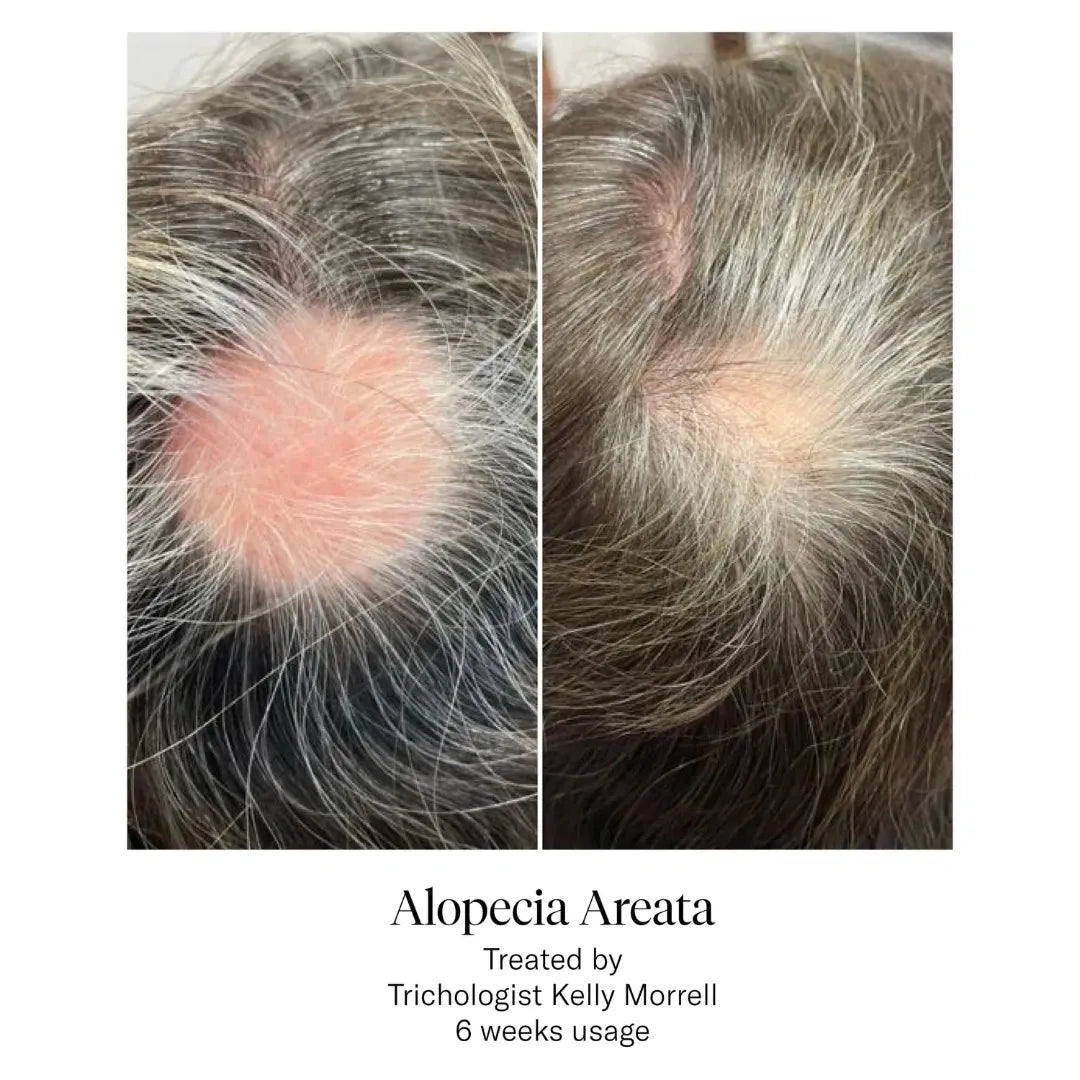 alopecia areata title with two photos side by side