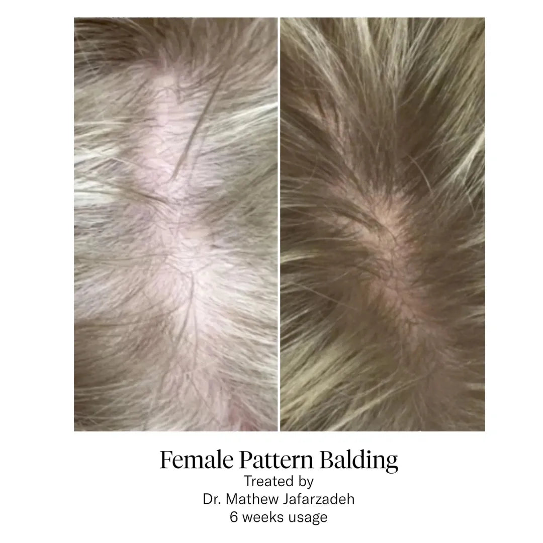two photos showing female pattern balding between 6 weeks usage