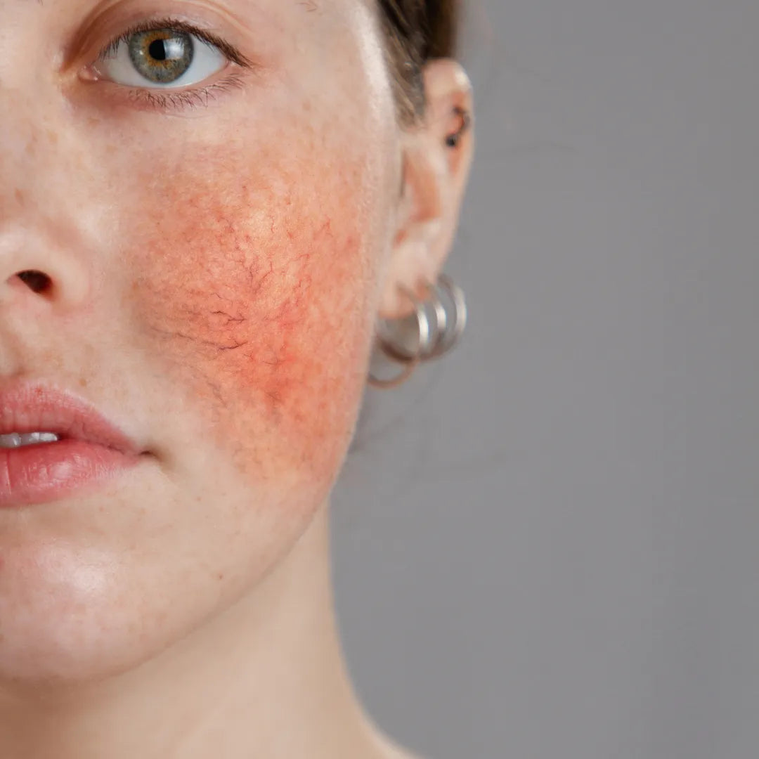 How to Care for Sensitive Skin: A Gentle Skincare Routine for Redness & Reactivity (Canada Guide)