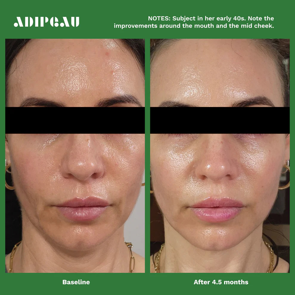 Before and after comparison of a woman's face with visible improvements around the mouth and mid-cheek area, labeled 'ADIPGAU'.