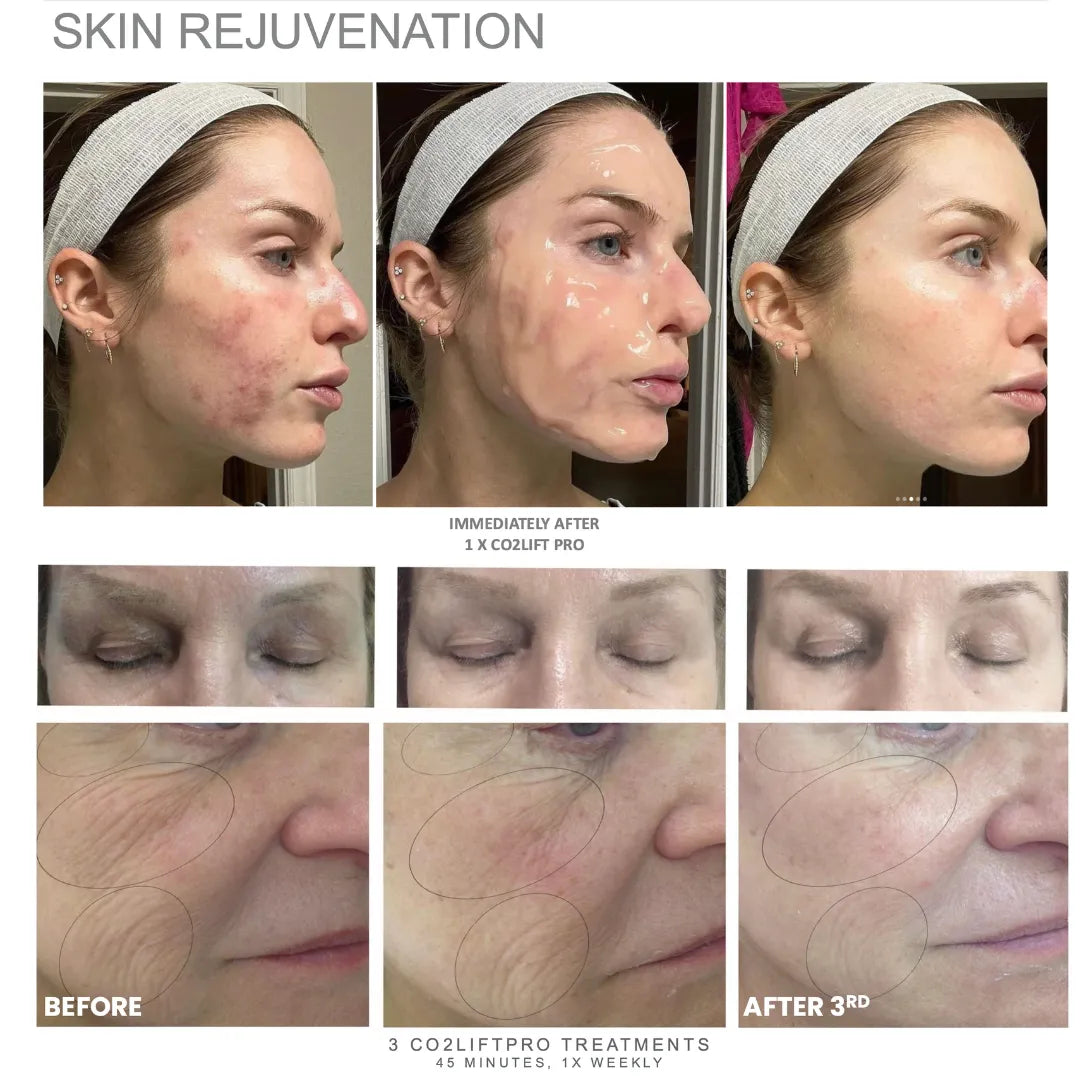 Before-and-after photos associated with CO2 Lift Pro Carboxy Therapy Topical Gel Mask showing a woman’s face with label text ‘skin rejuvenation’