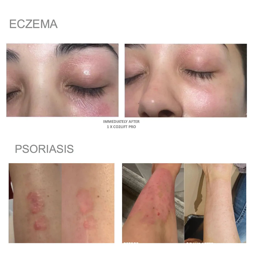 Before and after comparison of eczema and psoriasis on skin with text that says'immediately after 1 x CO2Lift Pro'