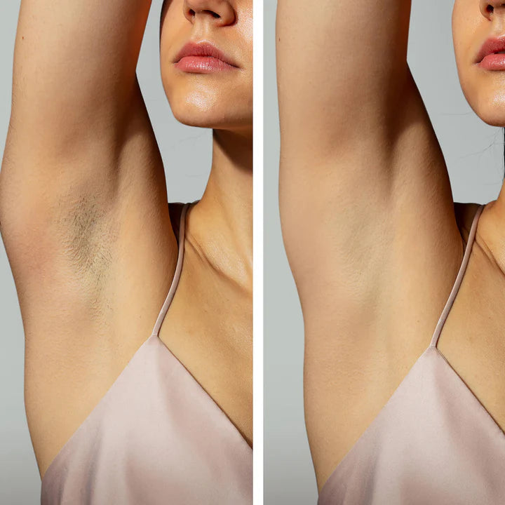 Before and after comparison of armpit hair removal on a woman wearing a beige top.