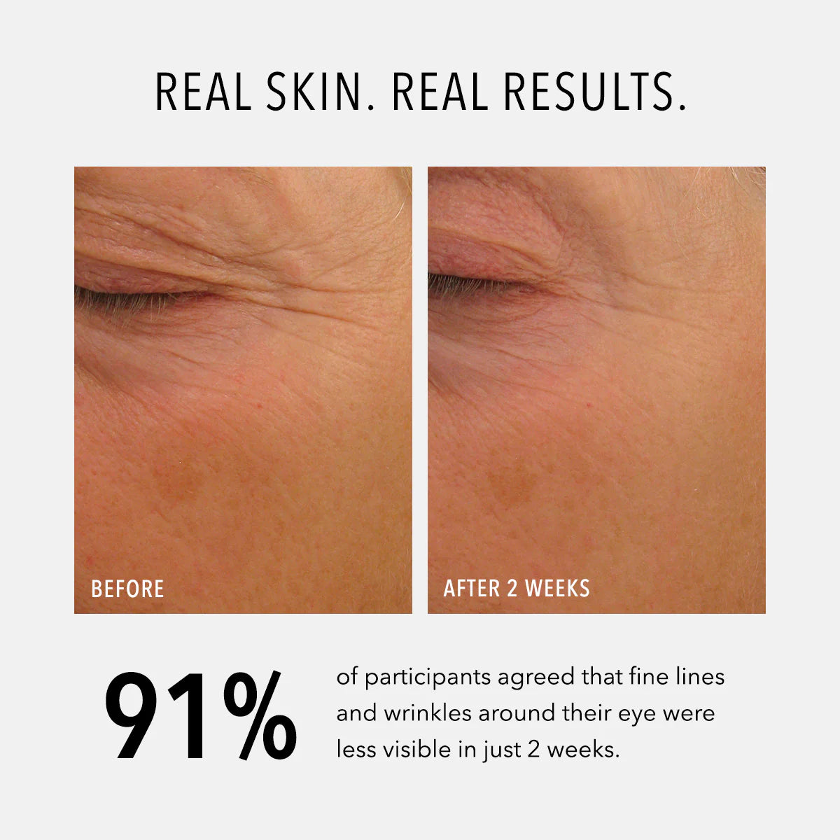 Before and after comparison of eye area with text about fine lines and wrinkles reduction.
