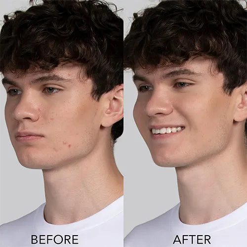 ESPADA™ 2 | Acne Treatment With Blue Light Therapy