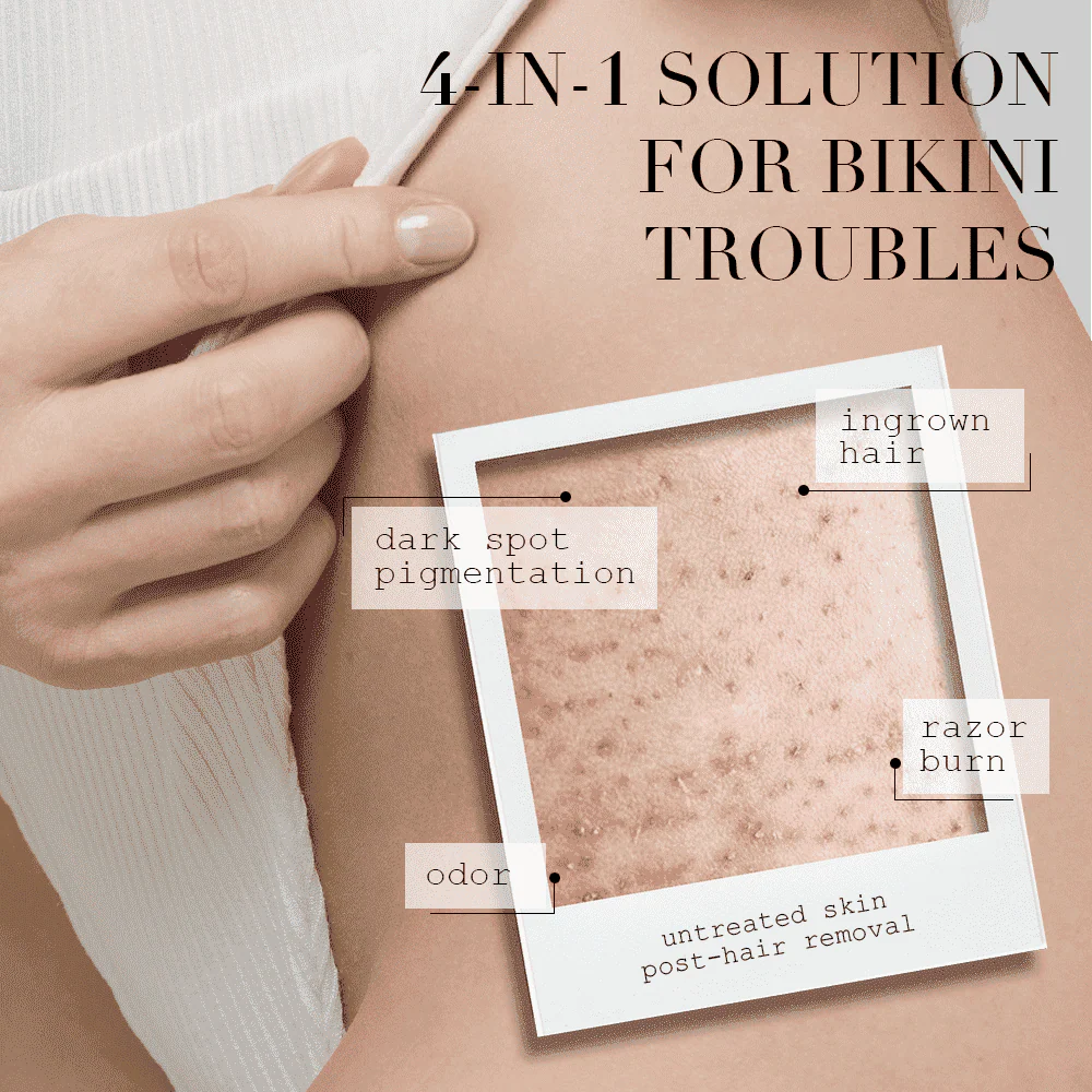 Advertisement for a 4-in-1 solution for bikini troubles with text labels on skin issues.